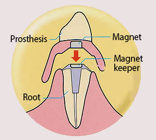 Denture magnet