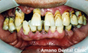 歯周病・歯槽膿漏治療前