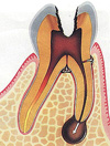 歯の神経を抜かない治療法/歯の神経を取らない治療法理由2
