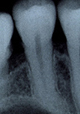 歯の神経を抜かない治療法/歯の神経を取らない治療法写真