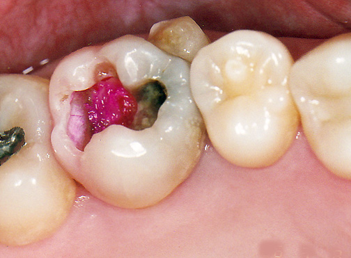 歯の神経を抜かない治療法/歯の神経を取らない治療法3Mix-MP法東京治療前