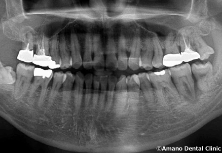 悪い噛み合わせによる歯の揺れ(咬合性外傷)実際例レントゲン