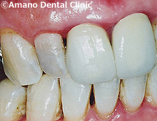 歯の神経を抜かない治療法/歯の神経を取らない治療法カリソルブ治療例（東京）後