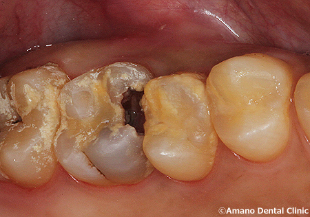 歯の神経を抜かない治療例/歯の神経を取らない治療例