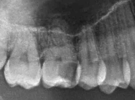 歯の神経を抜かない治療法/歯の神経を取らない治療法ドックベストセメント東京治療レントゲン