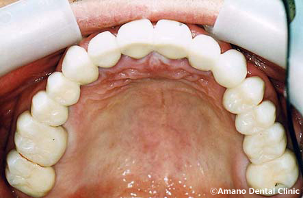 歯科恐怖症の治療後３７歳男性