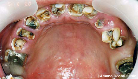 ひどい虫歯の治療例