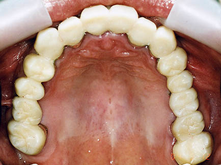 ひどい虫歯の治療後