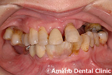 ひどい虫歯短期間治療