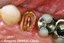 cracked tooth root