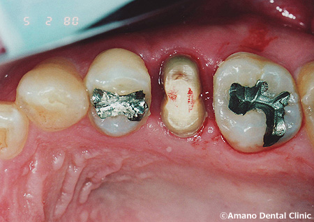 割れた歯の治療法５０歳治療中