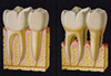 歯の強化痛くない虫歯歯周病治療P
