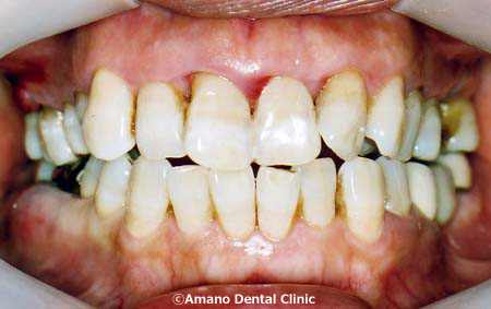 歯槽膿漏の治療法