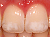 （歯の白い斑点(ホワイトスポット)治療写真