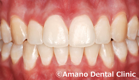 歯の白い斑点(ホワイトスポット)治療後