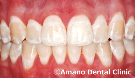 歯の白い斑点(ホワイトスポット)治療前