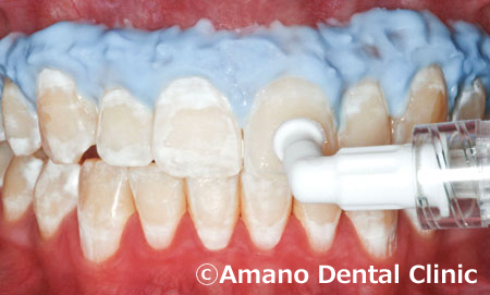 歯の白い斑点(ホワイトスポット)治療中