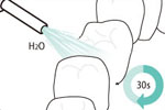 歯を削らない歯と歯の間(隙間)の虫歯治療図6