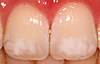 歯の白い斑点ホワイトスポット治療