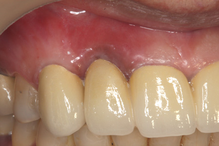 歯茎が黒い差し歯の治療後