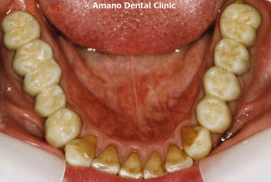 歯科恐怖症の治療後４２歳女性