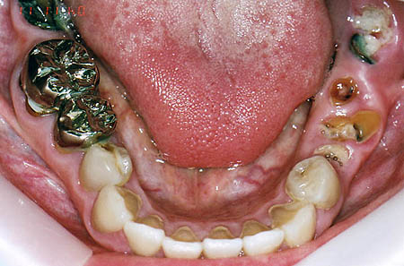 ひどい虫歯の治療前