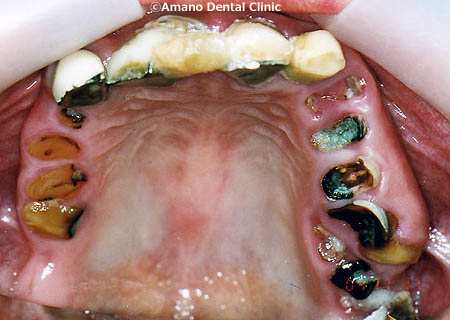 ひどい虫歯の治療前