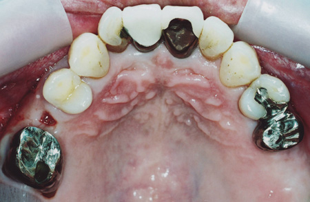 歯槽膿漏治療前４１歳男性