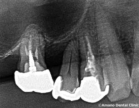 歯を削らない歯茎を切らないパーフェクトペリオ治療後