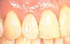 矯正治療後の歯茎を上げる治療2