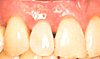 矯正治療後の歯茎を上げる治療1