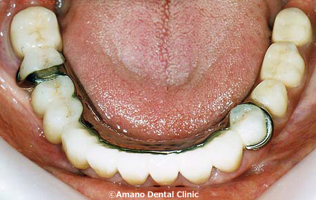 Titanium partial denture