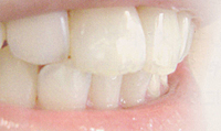 歯のエナメル質修復歯磨きアパガードリナメル歯