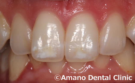 歯の白い斑点(ホワイトスポット)治療エナメル質形成不全治療前2