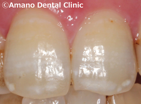歯の白い斑点(ホワイトスポット)治療エナメル質形成不全治療後1