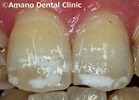 歯の白い斑点(ホワイトスポット)治療エナメル質形成不全治療前1