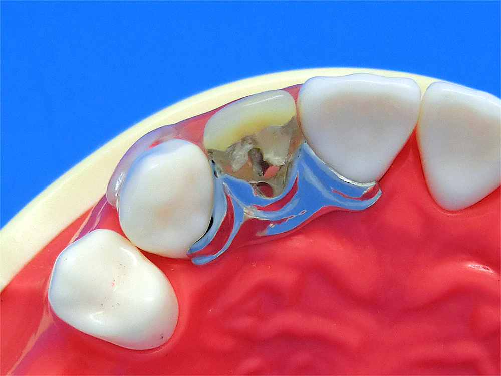歯科恐怖症入れ歯前歯治療例