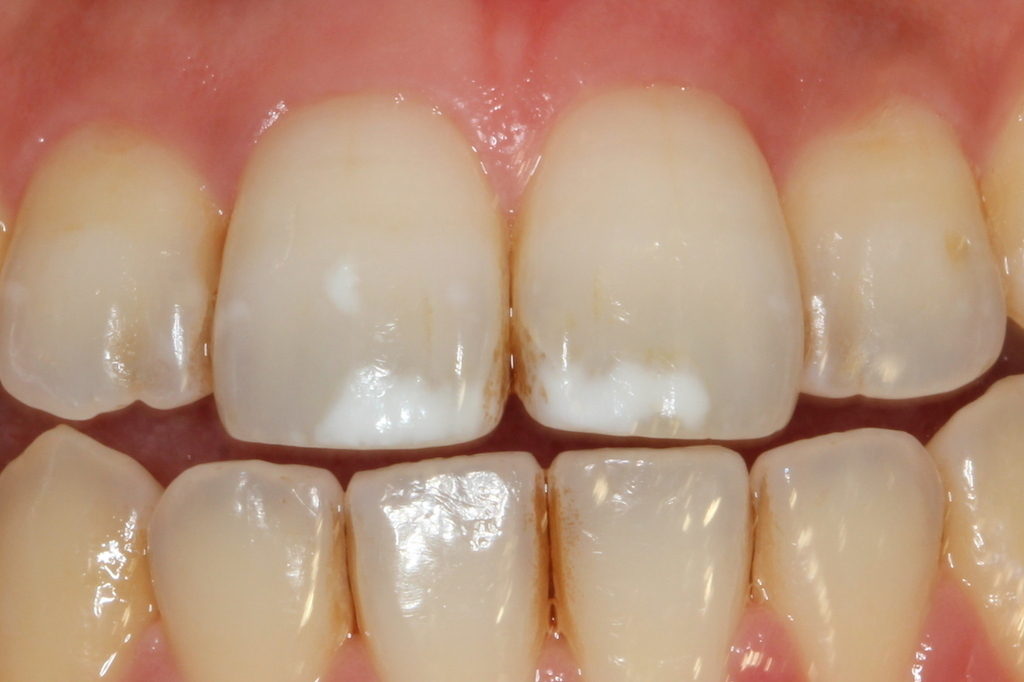 歯の白い斑点(ホワイトスポット)治療エナメル質形成不全治療前