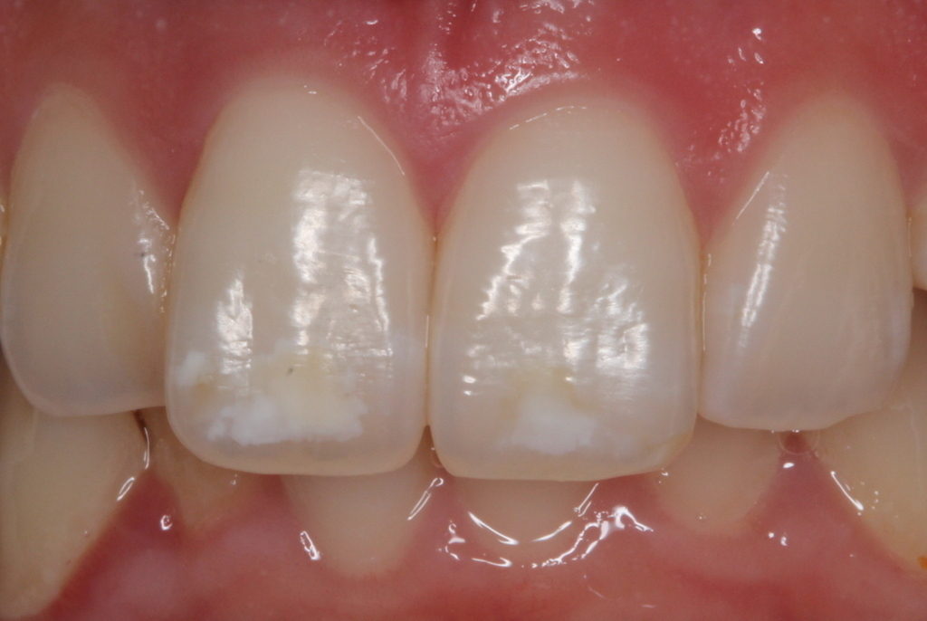 歯の白い斑点(ホワイトスポット)治療エナメル質形成不全治療前