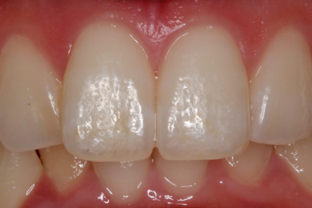 歯の白い斑点(ホワイトスポット)治療エナメル質形成不全治療後