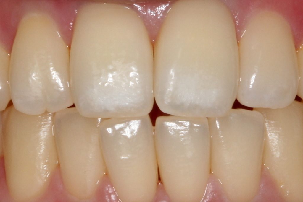 歯の白い斑点(ホワイトスポット)治療エナメル質形成不全治療後