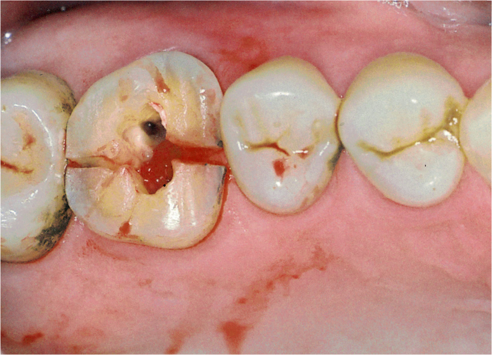 割れた歯の治療例